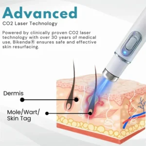 Non-Invasive Acne & Wart Removal Laser Pen with Heating (No Side Effect)